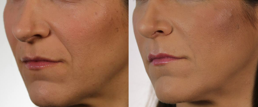 Before and after using Revanesse Versa to help with signs of aging. 