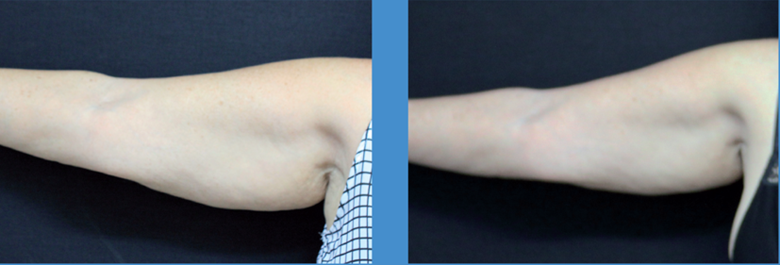 Before & After 8 treatments of Viora Laser Body Contouring. 