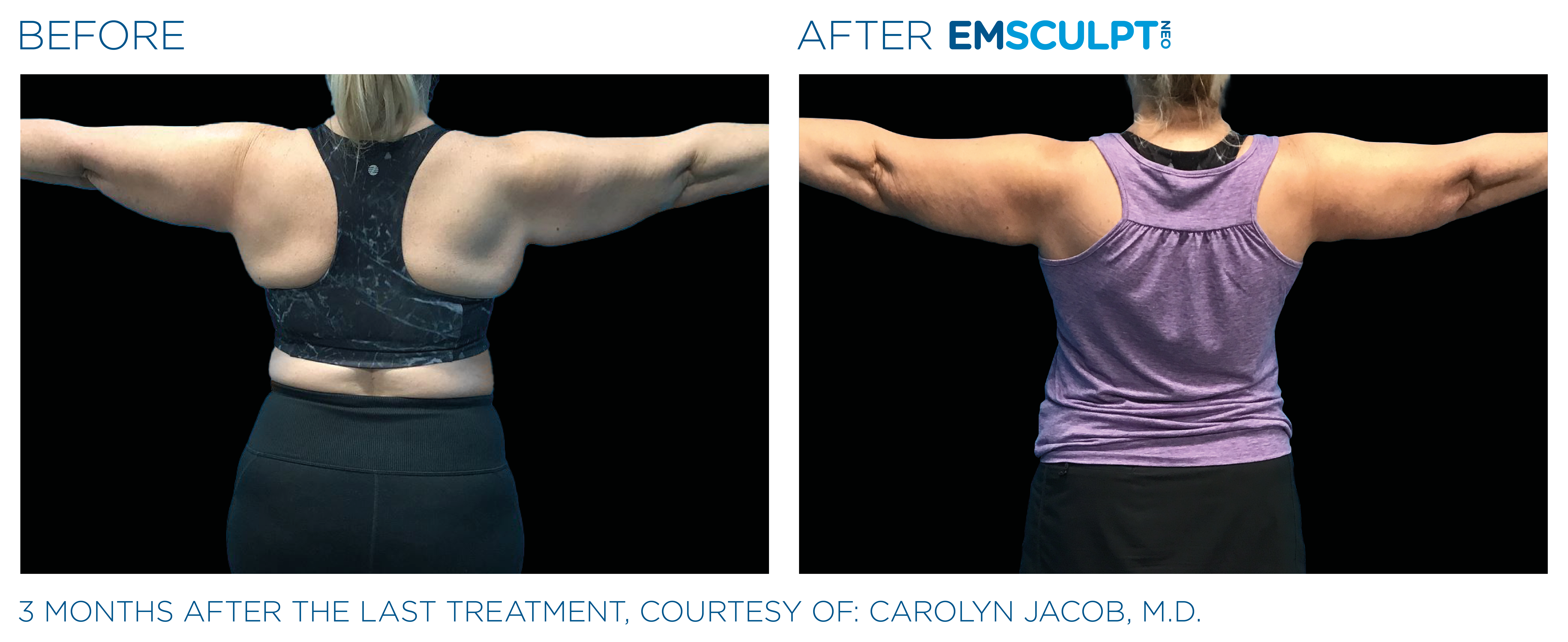 Before and after picture showing 3 months after the last Emsculpt Neo treatment, courtesy of Carolyn Jacob, M.D.