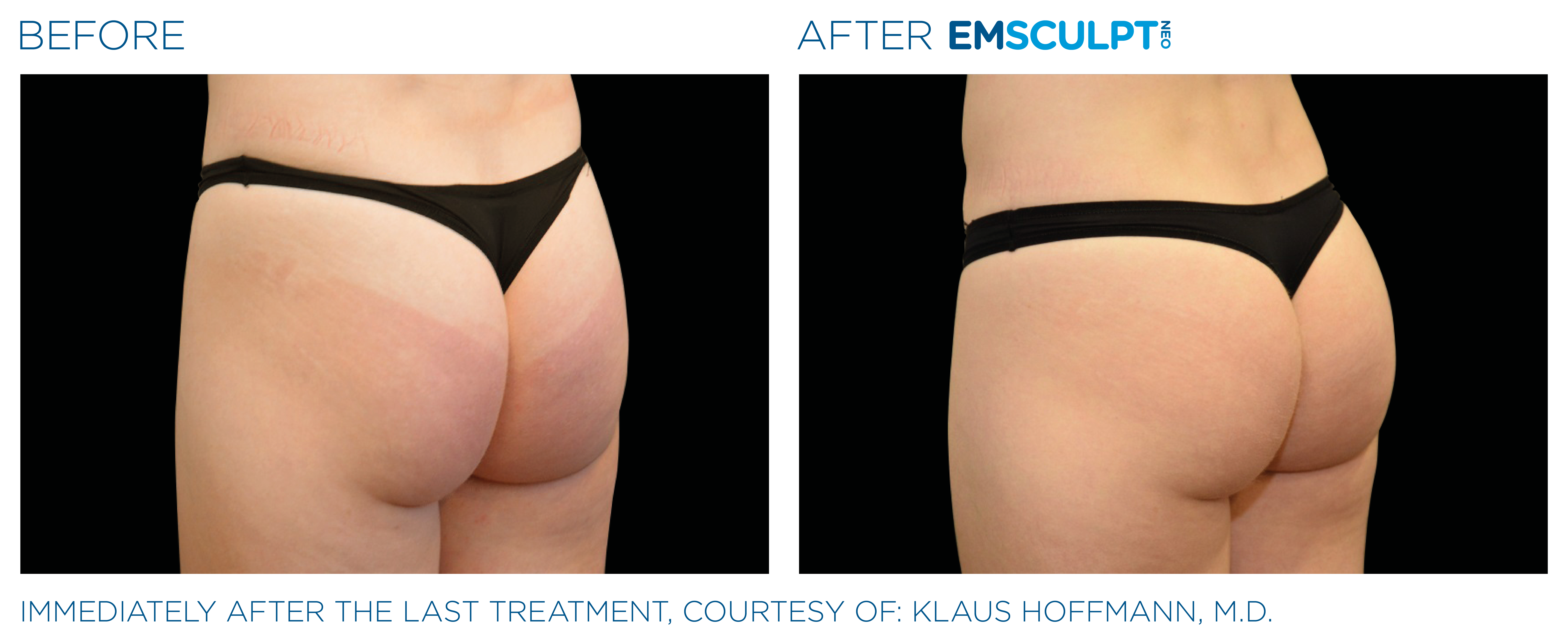 Before and after photo of womans buttocks with added text that states: Before on the left, After on the right. Immediately after the last treatment, courtesy of: Klaus Hoffman, M.D.