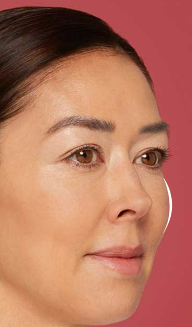 After Restylane® Contour 