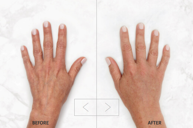 Before and after restylane lyft on hands.