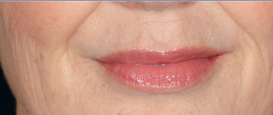 Before restylane treatment